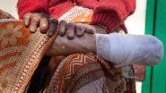 World Leprosy Day 2018: Know More About the Diagnosis and How to Eradicate the Disease