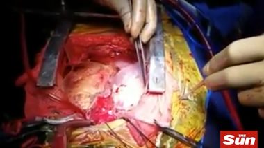 Video of a Rare Heart Surgery: Indian Man Has Two Beating Hearts After A Successful ‘Piggy-back’ Operation