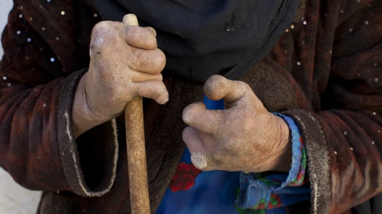 India Accounts for 60 Per Cent of World's Leprosy Patients: Japanese Philanthropist India Accounts for 60 Per Cent of World's Leprosy Patients: Japanese Philanthropist