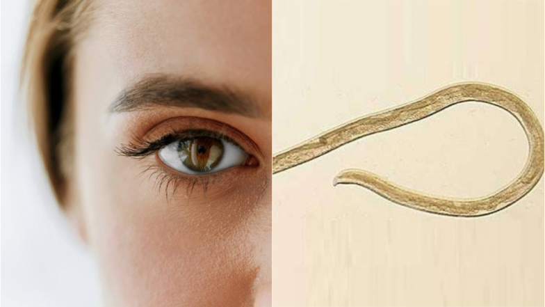 Fourteen Cattle Worms Found in a Woman's Eye: Here Are Some Horrific Pics of Parasites Found Inside Human Body