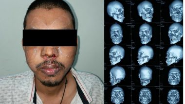 Accident Shatters Man's Face, Doctors Perform Complicated Surgery To Restore it
