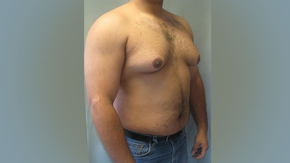 Male nipples female. Гинекомастия ожирение. Жирный мужик с гинекомастией. Гинекомастия при ожирении. Гинекомастия у мужчин фото.