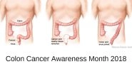 Colorectal Cancer Awareness Month: Diet Dos and Don&rsquo;ts to Reduce Colon Cancer Risk
