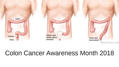 Colorectal Cancer Awareness Month: Diet Dos and Don’ts to Reduce Colon Cancer Risk