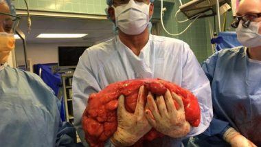 SHOCKING! Man's Beer Belly Turns Out To be a 13kg Tumour