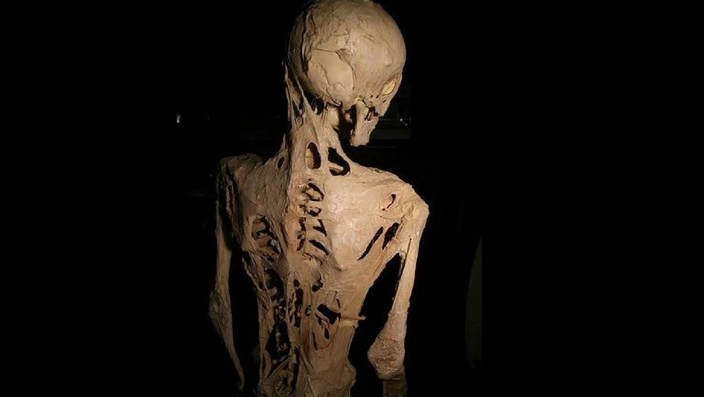 What’s a Rare Disease? Here are 6 Strange Diseases You’ve never Heard