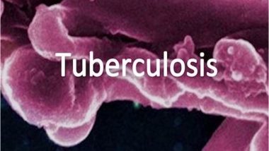 Genital Tuberculosis Can Impact Infertility in Women; Diagnosis is Difficult in Genital Organs