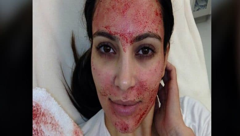 Vampire Facial is The Latest Fad in The Beauty World Vampire Facial is The Latest Fad in The Beauty World