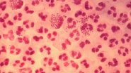 World's First Case of Super-Strength Antibiotic-Resistant Gonorrhoea Reported in UK