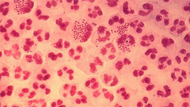 World's First Case of Super-Strength Antibiotic-Resistant Gonorrhoea Reported in UK