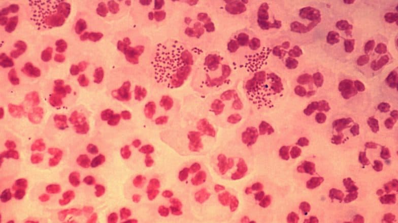 British man suffering from the 'worst ever' case of gonorrhoea British man suffering from the 'worst ever' case of gonorrhoea