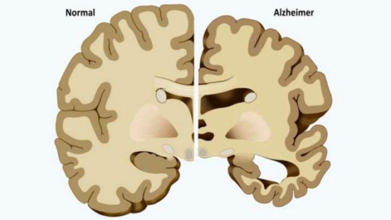 World Alzheimer’s Day 2018: Removing ‘Zombie’ Cells Helps Prevent Alzheimer’s Disease in Mice
