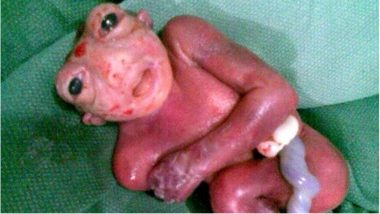 Anencephaly Affects the Skull of the Newborn: Know Causes, Symptoms, Diagnosis & Treatment of This Neural Tube Defect