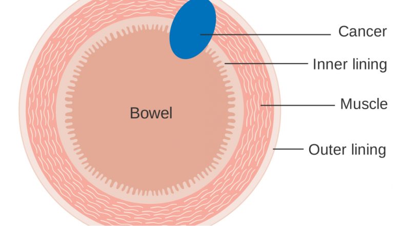 Bowel Cancer Awareness Month: Know About the Causes and 