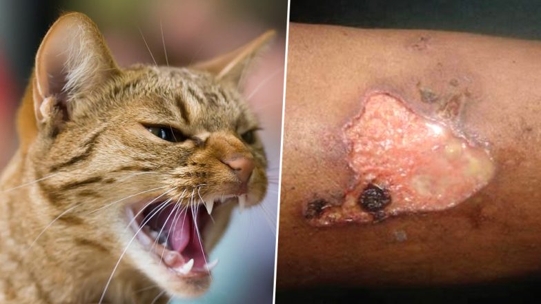 Woman Scratched By Cat on Breast Develops Rare Flesh-Eating Disease Called Pyoderma Gangrenosum