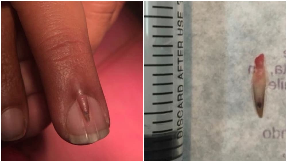 Shocking Pics Stani Man Develops An Extra Nail Growing From His Double Nail Removed From Man S Finger Photo Credits Sciencedirect