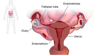 Endometriosis Symptoms, Causes and Early Signs