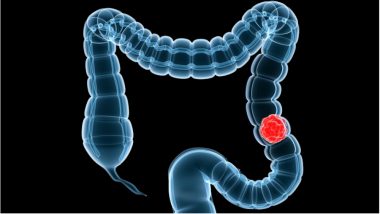 Six Members of Vadodara Family Diagnosed with Familial Adenomatous Polyposis (FAP), Cancer of the Large Intestine