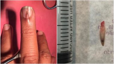 Shocking Pics! Pakistani Man Develops an Extra Nail Growing from His Middle Finger