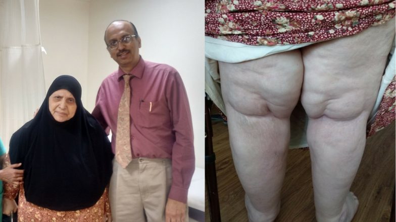 Immobile Iraqi Woman Walks After 15 Years, Thanks to Indian Doctors