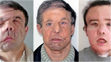 French Man Becomes First to Undergo Second Face Transplant! The 43-Year-Old Patient Feels Young Like a 22-Year Old