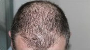 Treat Hair Loss With This Novel Drug