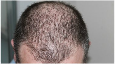 Treat Hair Loss With This Novel Drug | 👗 LatestLY