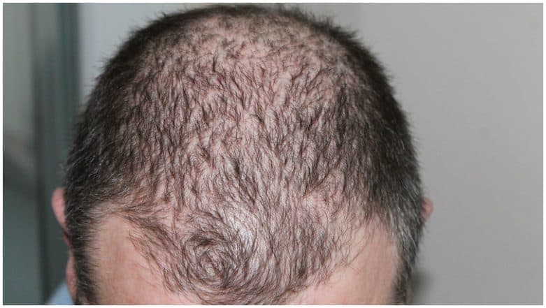 Treat Hair Loss With This Novel Drug Treat Hair Loss With This Novel Drug
