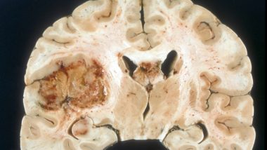 Scientists Acquaint New Methodology With Improved Treatment of Brain Tumours