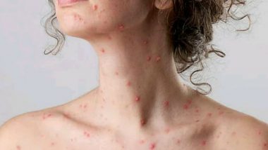 Chicken Pox Cases on Rise in Hyderabad, Summer Can be a Reason, Say Doctors