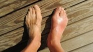 Gout Won't Increase Fracture Risk in Arthritis Patients, Says Study
