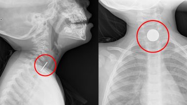 Nashik Boy Accidentally Swallows a Rs 2 Coin X-ray image