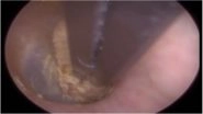 Cotton Bud Stuck in Man&rsquo;s Ear for Two Years, Watch the Disgusting Video How an Audiologist Removes it