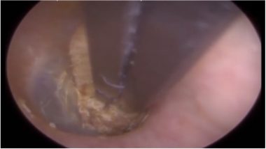 Cotton Bud Stuck in Man’s Ear for Two Years, Watch the Disgusting Video How an Audiologist Removes it