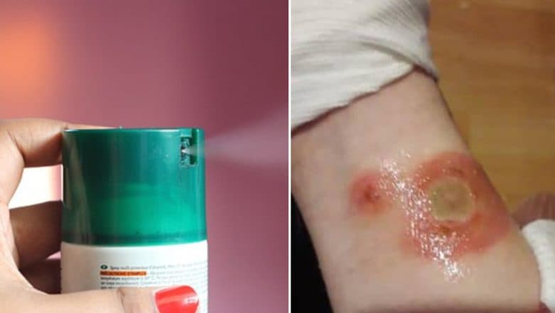 Deodorant Challenge is New Craze Among Teenagers, UK Mother Warns Against Internet Challenge as Daughter Suffers Burns