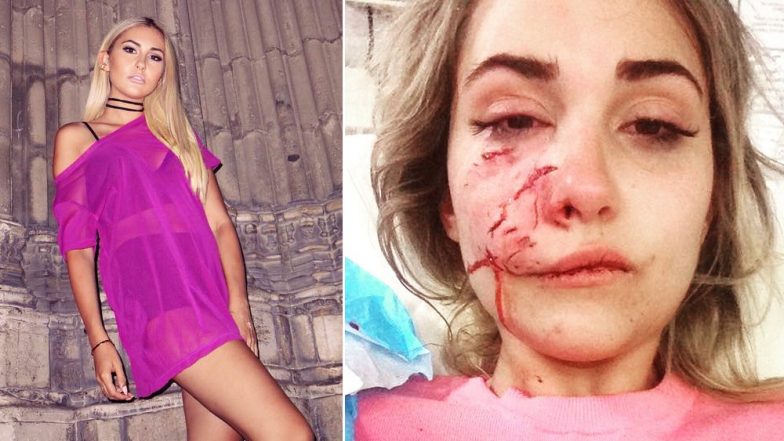 Female Australian Model's Face Mauled by Dog, Undergoes Plastic Surgery, Says She Will Rebuild Her Career