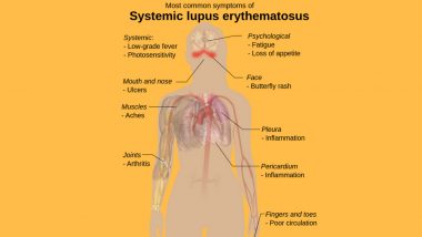 World Lupus Day 2020 Date & Significance: How Is the Day Celebrated? Know More About the Observance Dedicated to the Autoimmune Disease