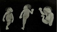 Mermaid Baby Born in Hyderabad Dies Withing Hours: What Is 'Mermaid Syndrome'? Everything You Want to Know About Sirenomelia