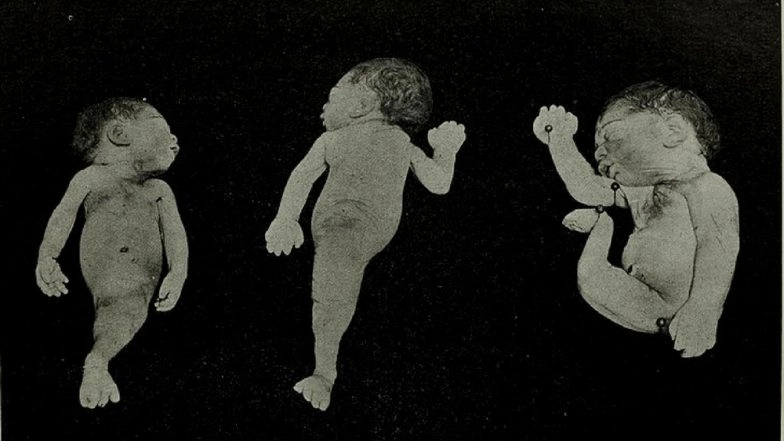 Mermaid Baby Born in Hyderabad Dies Withing Hours: What Is 'Mermaid Syndrome'? Everything You Want to Know About Sirenomelia