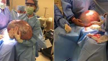 50-Pound Ovarian Cyst Removed from Alabama Woman Who Was Asked to ‘Lose Weight’: See Shocking Images