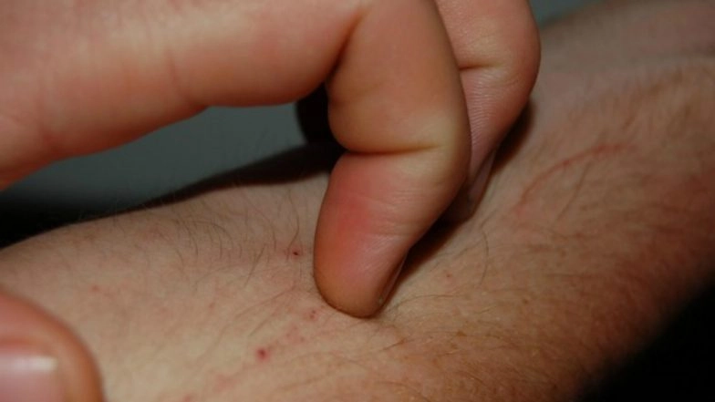 Men's Health Month 2020: What Causes Fungal and Yeast Infections in Men? From High Sugar Diet to Antibiotic Usage, These are the Common Culprits