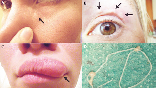 A Moving Lump in a Woman’s Face Turned out to be A Live Worm! View Pics of Migrating Dirofilaria Repens