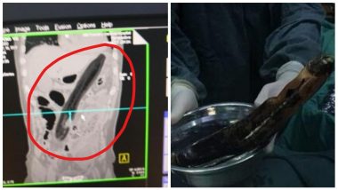 Man Shoves Eggplant In To His Anus to Relieve Constipation, Ends Up In Hospital