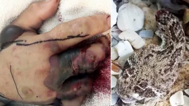 Are Rattlesnakes Poisonous? Man Bitten by a Severed Head of Snake Almost Faced Death, Watch Video