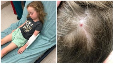 Five-Year-Old Girl Paralysed By A Tick Bite, Mother Discovers Blood-Sucking Insect On The Child's Scalp