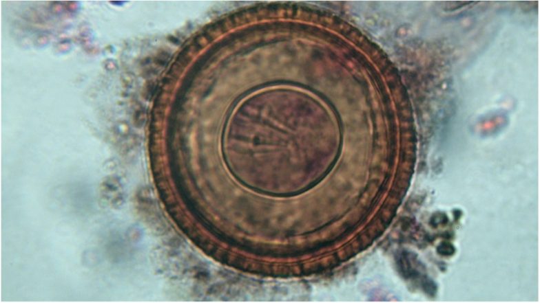100 Tapeworm Eggs Found in Eight-Year-Old's Gurugram Girl's Brain! Suffered from Epileptic Seizures and Headaches