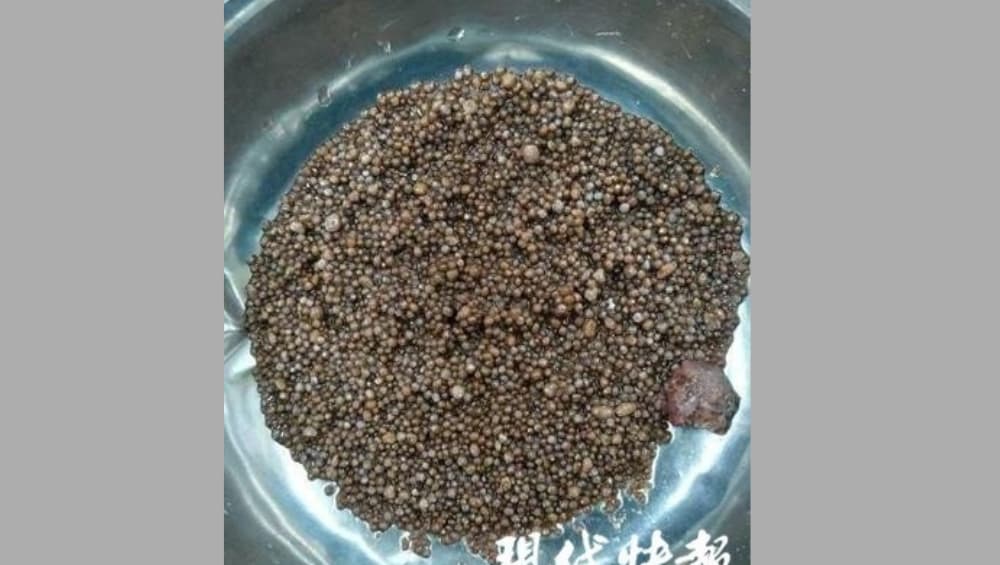 Around 3,000 Kidney Stones Found In Chinese Woman’s Body After She