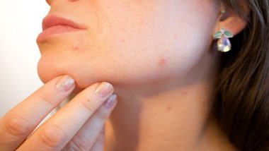 Foods That Causes Acne: 5 Worst Acne-causing Staple As Well As Junk Food That You Must Avoid