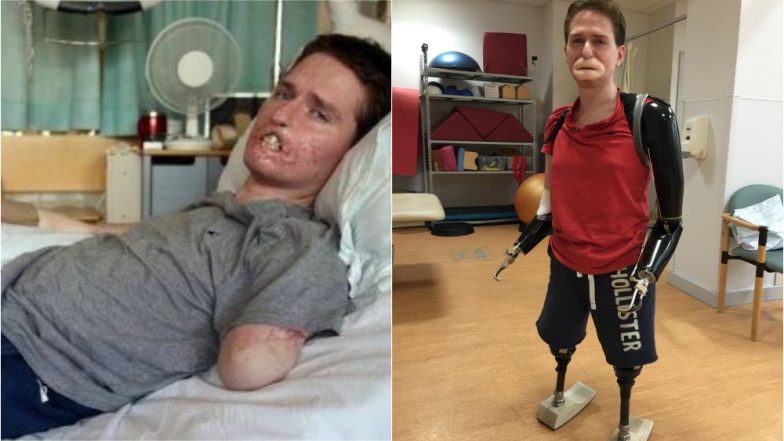Man Lost All Four Limbs & Lips to a Flesh-Eating Bug, Gets New Lips Tattooed on His Face