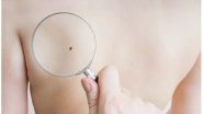 World's First Blood Test to Detect Melanoma Developed by Australian Scientists